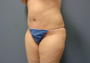 Tummy Tuck Before and After Pictures Nashville, TN