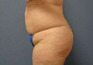 Tummy Tuck Before and After Pictures Nashville, TN