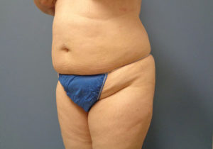 Tummy Tuck Before and After Pictures Nashville, TN