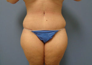 Tummy Tuck Before and After Pictures Nashville, TN