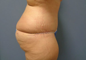 Tummy Tuck Before and After Pictures Nashville, TN