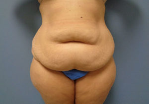 Tummy Tuck Before and After Pictures Nashville, TN