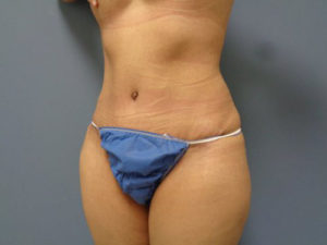 Tummy Tuck Before and After Pictures Nashville, TN