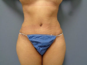 Tummy Tuck Before and After Pictures Nashville, TN