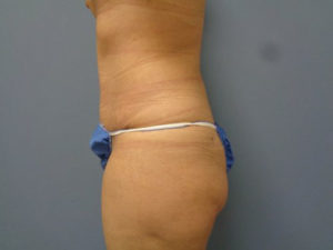 Tummy Tuck Before and After Pictures Nashville, TN