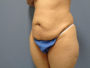 Tummy Tuck Before and After Pictures Nashville, TN