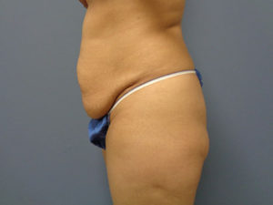 Tummy Tuck Before and After Pictures Nashville, TN