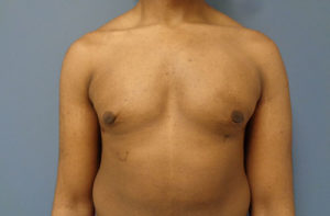 Gynecomastia Before and After Pictures Nashville, TN