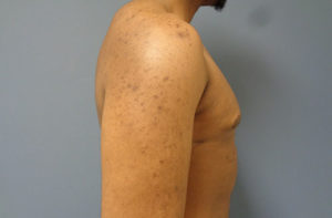 Gynecomastia Before and After Pictures Nashville, TN