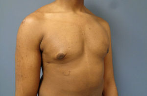 Gynecomastia Before and After Pictures Nashville, TN