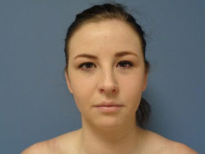 Otoplasty Before and After Pictures Nashville, TN