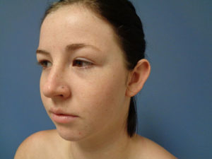 Otoplasty Before and After Pictures Nashville, TN