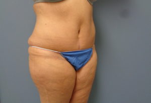 Tummy Tuck Before and After Pictures Nashville, TN