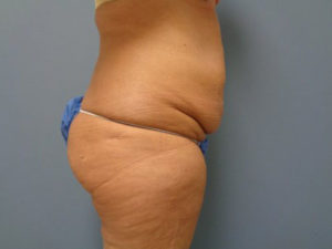 Tummy Tuck Before and After Pictures Nashville, TN