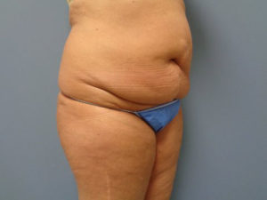 Tummy Tuck Before and After Pictures Nashville, TN