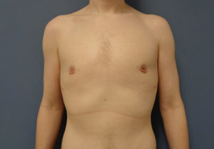 Gynecomastia Before and After Pictures Nashville, TN