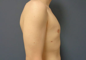 Gynecomastia Before and After Pictures Nashville, TN