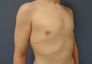 Gynecomastia Before and After Pictures Nashville, TN