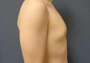 Gynecomastia Before and After Pictures Nashville, TN