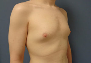 Gynecomastia Before and After Pictures Nashville, TN