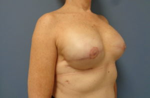 Breast Reconstruction Before and After Pictures Nashville, TN
