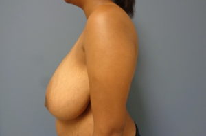 Breast Reduction Before and After Pictures Nashville, TN