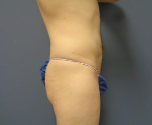 Liposuction Before and After Pictures Nashville, TN