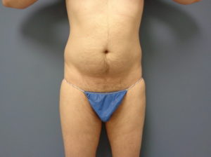 Liposuction Before and After Pictures Nashville, TN