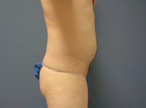 Liposuction Before and After Pictures Nashville, TN