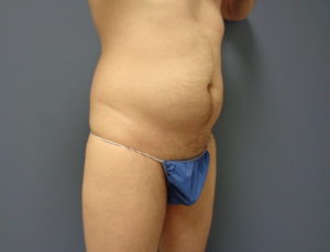 Liposuction Before and After Pictures Nashville, TN