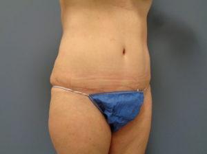 Tummy Tuck Before and After Pictures Nashville, TN