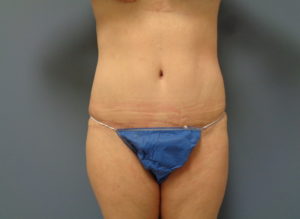 Tummy Tuck Before and After Pictures Nashville, TN