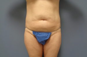 Tummy Tuck Before and After Pictures Nashville, TN