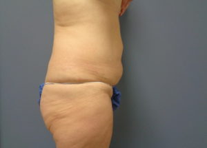 Tummy Tuck Before and After Pictures Nashville, TN