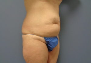 Tummy Tuck Before and After Pictures Nashville, TN