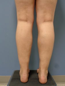 Liposuction Before and After Pictures Nashville, TN