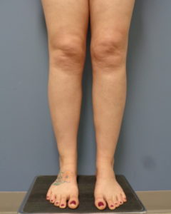 Liposuction Before and After Pictures Nashville, TN