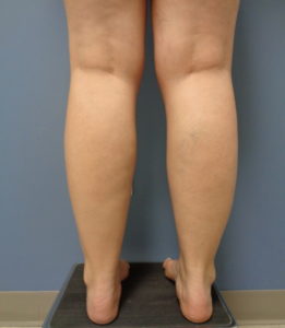 Liposuction Before and After Pictures Nashville, TN