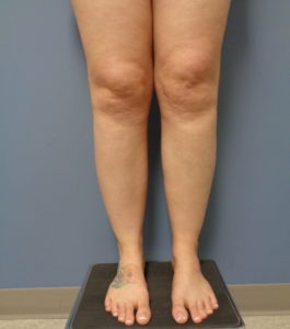 Liposuction Before and After Pictures Nashville, TN