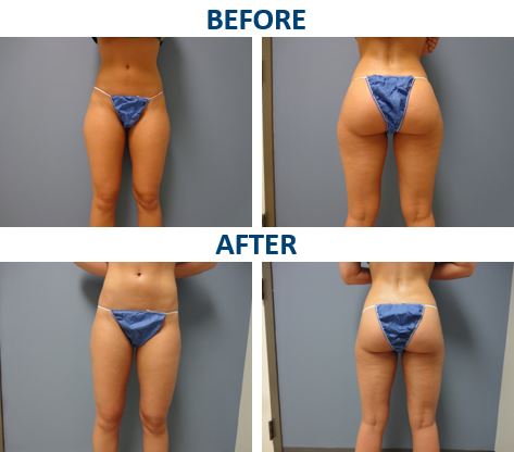 Liposuction Before and After Pictures Nashville, TN