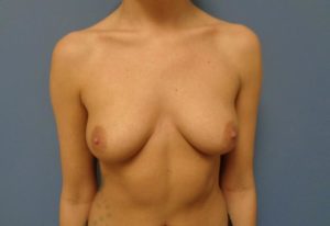 Breast Augmentation Before and After Pictures Nashville, TN