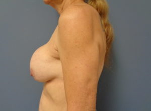 Implant Exchange Before and After Pictures Nashville, TN