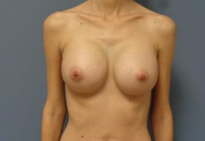 Breast Augmentation Before and After Pictures Nashville, TN