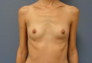 Breast Augmentation Before and After Pictures Nashville, TN