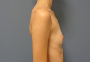 Breast Augmentation Before and After Pictures Nashville, TN