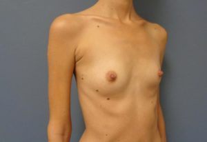 Breast Augmentation Before and After Pictures Nashville, TN