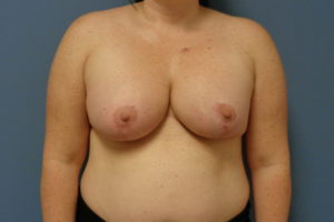 Breast Augmentation with Lift Before and After Pictures Nashville, TN