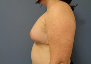 Breast Augmentation with Lift Before and After Pictures Nashville, TN