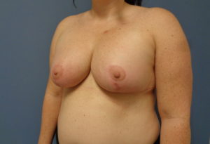 Breast Augmentation with Lift Before and After Pictures Nashville, TN