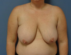 Breast Augmentation with Lift Before and After Pictures Nashville, TN